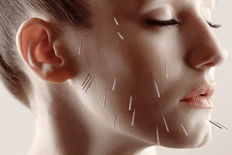 Benefits of Cosmetic Facial Acupuncture